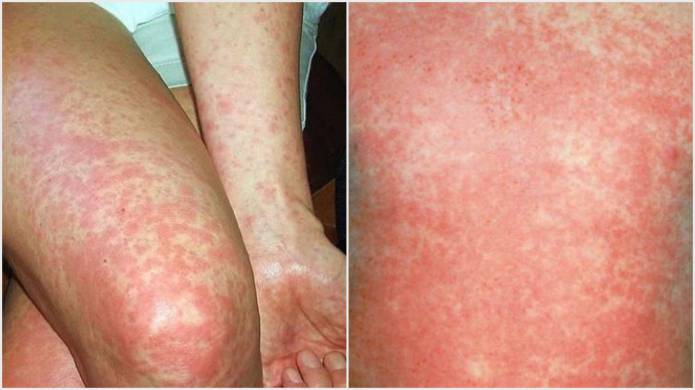 SOMERSET NEWS: Scarlet fever on the increase in Somerset