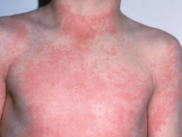 SOMERSET NEWS: Scarlet fever on the increase in Somerset
